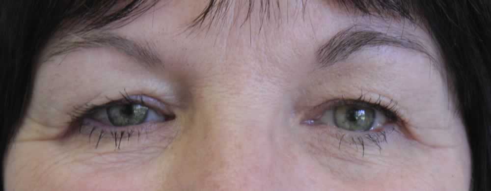 Phthisical Eye - Eyes Alive